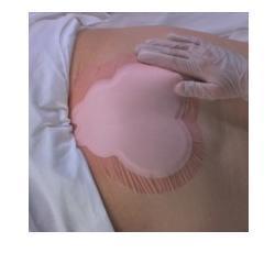 MEDICAZIONE IDROCELLULARE ADESIVA STERILE CONFORMATA PER LA REGIONE SACRALE ASSORBENTE IN SCHIUMA DI POLIURETANO ALLEVYN SACRUM 22,5X22,1CM 10PZ - Farmacia Dott. Pasquale Russo